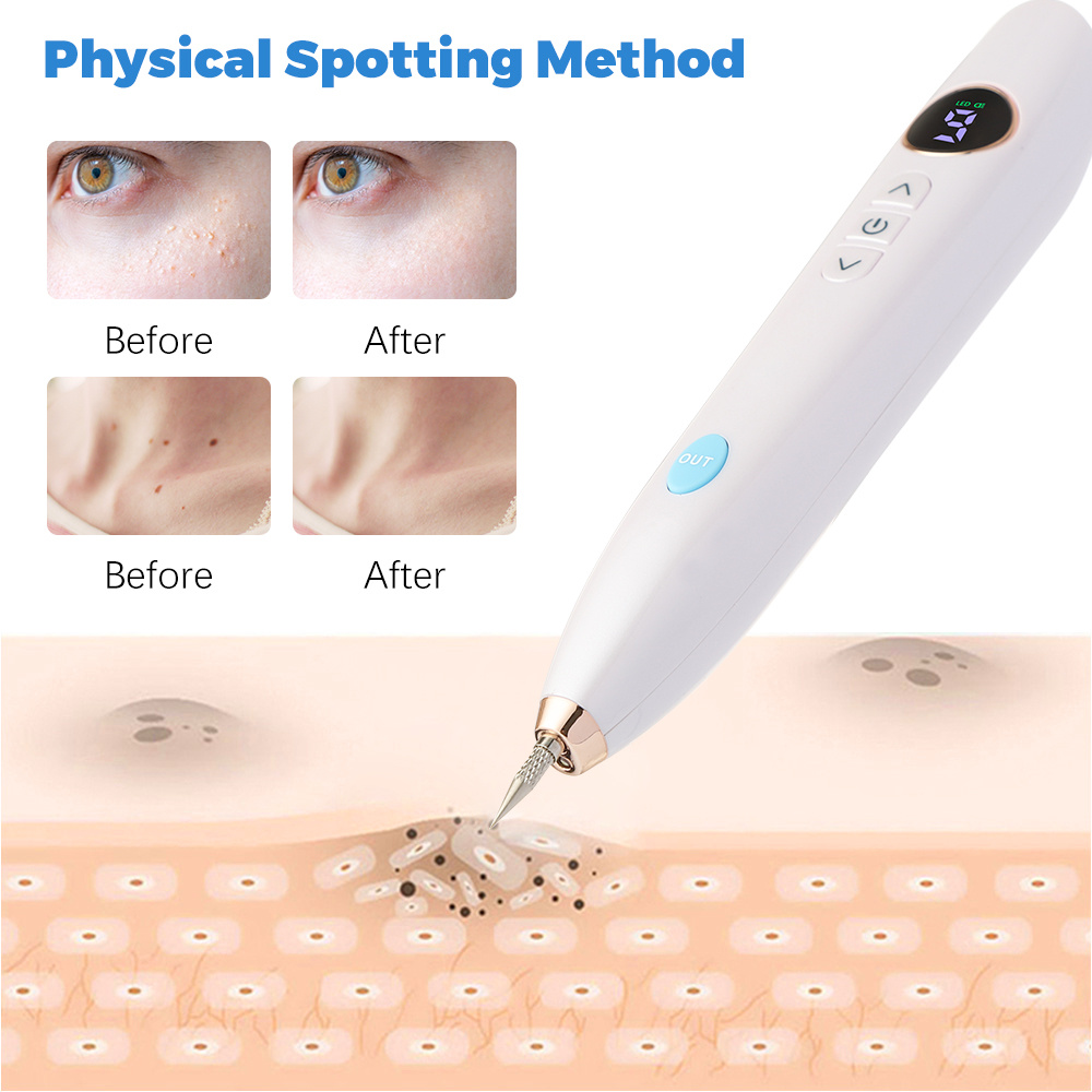 Laser Skin Tag & Mole Remover